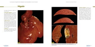La necropsia en el ganado porcino, diagnóstico anatomopatológico y toma de muestras

Hígado

Evaluación macroscópica de vísceras

A

Las lesiones macroscópicas hepáticas de
mayor interés son:

•

Anomalías congénitas. La más habitual
es la melanosis maculosa, consistente en la
presencia de manchas oscuras en la superficie
hepática. Estas manchas son de color negro
en animales recién nacidos y de coloración
grisácea que va empalideciendo a medida
que el animal crece. El origen de este hallazgo se asocia a la migración aberrante de
melanocitos durante la embriogénesis.

• Necrosis

hepática. Consiste en la
necrosis focal, multifocal o difusa del hígado.
Macroscópicamente se suele observar un
marcado patrón lobulillar, de manera que el
centro de los lóbulos hepáticos es de un
color rojizo, con un color más claro en la
zona perilobulillar –Figs. 140A y 140B–. Se
suele asociar a ciertas infecciones víricas
(enfermedad de Aujeszky y a la circovirosis
porcina) y bacterianas (infección por Salmonella typhisuis), y a deficiencias de ciertos
nutrientes (deficiencia de vitamina E y de
selenio: hepatosis dietética). Macroscópicamente, las lesiones necrotizantes extensas
del hígado cursan con ictericia generalizada.

• Pigmentaciones. La más frecuente es la

ictericia, que supone la acumulación de pigmentos biliares en el tejido hepático. Se suele
asociar a ciertas infecciones víricas (caso de la
circovirosis porcina), bacterianas (caso de leptospirosis), protozoarias y parasitarias, y también a procesos de intoxicación (intoxicación
por cobre) y deficiencia de minerales (deficiencia de selenio).

B

• Depósitos. El más habitual es la acumula-

ción de lípidos (metamorfosis grasa –Fig.
139–), que confiere un aspecto amarillento o
de color marrón claro al hígado.

Fig. 139
Coloración amarillo-anaranjada del hígado en un caso de lipidosis hepática.
80

Fig. 140
Necrosis centrolobulillar y hemorragia (coloración rojiza de los lobulillos) en un caso de hepatosis dietética (A).
Imagen similar a la anterior pero sin hemorragia centrolobulillar. El edema en la pared de la vesícula biliar es frecuente en casos
de hepatosis dietética (B).
81

 