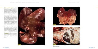 La necropsia en el ganado porcino, diagnóstico anatomopatológico y toma de muestras

Evaluación macroscópica de vísceras

•

Inflamación (hepatitis). Se define
como la presencia de infiltrado inflamatorio
en el parénquima hepático. En el ganado porcino, la forma mas típica es la producida por
la migración de larvas de Ascaris suum en el
parénquima hepático, dando la típica imagen
de manchas blanquecinas multifocales conocida como “manchas de leche” (hepatitis
parasitaria –Fig. 141–). En infecciones por
micobacterias (Mycobacterium avium, especialmente) también se puede producir hepatitis granulomatosa; macroscópicamente se
observa la presencia de nódulos en todo el
parénquima del hígado, que al corte contienen un exudado inflamatorio caseoso.
En ciertas infestaciones protozoarias (caso de
Toxoplasma gondii), se dan hepatitis necrotizantes (multifocales), aunque no se observan
lesiones macroscópicas habitualmente. En
infecciones bacterianas que cursan con septicemia (caso de bacterias que provocan cuadros de poliserositis), es frecuente que ocurra
una extravasación de fibrina y se forme un
exudado inflamatorio fibrinoso en la superficie de muchos órganos. En el caso del hígado
se describe como perihepatitis fibrinosa –Fig.
142–, y la cronificación de esta lesión es la
perihepatitis fibrosa –Fig. 143–.

Fig. 142
Depósito de fibrina en la superficie del hígado en un caso de poliserositis fibrinosa causado por Haemophilus parasuis.

• Neoplasias:en casos muy raros se puede

observar linfosarcoma. Macroscópicamente
se caracteriza por la presencia de nódulos
blanquecinos o amarillentos, distribuidos de
forma multifocal por todo el parénquima
hepático.

Fig. 141
Típicas “manchas de leche” causadas por la migración de larvas de Ascaris suum en el parénquima hepático.
82

Fig. 143
Adherencias fibrosas entre asas intestinales (peritonitis fibrosa) y en la superficie hepática (perihepatitis fibrosa);
hígado con “manchas de leche”.
83

 