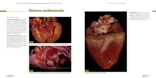 La necropsia en el ganado porcino, diagnóstico anatomopatológico y toma de muestras

Evaluación macroscópica de vísceras

Sistema cardiovascular

• Atrofia serosa –Fig. 146–. Consiste en la

sustitución de la grasa situada en la zona
subepicárdica, generalmente a la altura del
surco coronario del corazón, por una sustancia gelatinosa translúcida. Se asocia a estados
de emaciación o caquexia del animal.

En el corazón se describen:

•

Anomalías congénitas. Son relativamente poco frecuentes en el ganado porcino.
Entre las más habituales se debe destacar la
persistencia de foramen oval (observable
como un orificio en el tabique interventricular que mantiene la comunicación entre el
ventrículo derecho y el izquierdo), y la estenosis subaórtica –Fig. 144– (caracterizada
por la presencia de una banda fibrosa por
debajo de la válvula aórtica, la cual provoca
una constricción de esta válvula).

•

Trastornos circulatorios. Se considera
básicamente el cúmulo de líquido en la cavidad pericárdica (hidropericardio –Fig. 145–).
Es un hallazgo relativamente habitual en casos
de infecciones bacterianas sistémicas, estados
agónicos del animal, deficiencia de ciertos
nutrientes (vitamina E y selenio) y en todas
aquellas situaciones que provocan una alteración de la permeabilidad vascular.

Fig. 144
Banda fibrosa por debajo de la válvula aórtica (flecha), la cual provoca una constricción de esta válvula (estenosis subaórtica).

Fig. 145
Masiva presencia de líquido en las cavidades pericárdica (hidropericardio) y torácica (hidrotórax), además de una pericarditis fibrinosa.
84

Fig. 146
Gelatinización de la grasa subepicárdica del corazón (atrofia serosa).
85

 