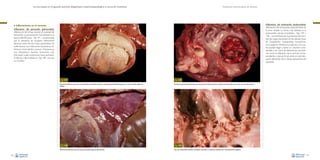 La necropsia en el ganado porcino, diagnóstico anatomopatológico y toma de muestras

Evaluación macroscópica de vísceras

Inflamación del endocardio (endocarditis):
inflamación del endocardio, especialmente en
la zona valvular. La forma más habitual es la
endocarditis valvular trombótica –Figs. 149 y
150–, caracterizada por la presencia de trombos de origen bacteriano en las válvulas (caso
de Erysipelothrix rhusiopathiae, Arcanobacterium pyogenes, Streptococcus spp., etc.), los cuales pueden llegar a tener un volumen considerable y ser causa de alteraciones secundarias como la dilatación de la aurícula correspondiente y cianosis. En el cerdo es más habitual la afectación de la válvula atrioventricular
izquierda.

• Inflamaciones en el corazón:
Inflamación del pericardio (pericarditis):
inflamación de la hoja visceral y/o parietal del
pericardio. La presentación más habitual es la
pericarditis fibrinosa –Fig. 147–, caracterizada
por la presencia de exudado inflamatorio
fibrinoso entre las dos hojas pericárdicas. Se
suele asociar con infecciones bacterianas sistémicas (Haemophilus parasuis, Streptococcus
suis, Mycoplasma hyorhinis, Escherichia coli).
Esta lesión suele evolucionar hacia pericarditis fibrosa o fibro-adhesiva –Fig. 148– una vez
se cronifica.

Fig. 147
Presencia de fibrina que cubre las superficies pericárdicas visceral y parietal (pericarditis fibrinosa) en un caso de enfermedad de
Glässer.

Fig. 148
Adherencias fibrosas entre las hojas pericárdicas (pericarditis fibrosa).
86

Fig. 149
Trombo de grandes dimensiones que casi provoca obstrucción de la válvula atrioventricular en un caso de mal rojo crónico.

Fig. 150
Caso de endocarditis valvular trombótica asociada a la infección sistémica por Arcanobacterium pyogenes.
87

 