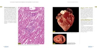 La necropsia en el ganado porcino, diagnóstico anatomopatológico y toma de muestras

Evaluación macroscópica de vísceras

Inflamación del miocardio (miocarditis –Fig.
151–): cúmulo de infiltrado inflamatorio,habitualmente mononuclear, entre las fibras musculares cardiacas. Este hallazgo se acompaña
frecuentemente con necrosis de fibras miocárdicas. Macroscópicamente, en aquellos
casos en los cuales la lesión es intensa, se suelen observar bandas de decoloración del
miocardio (normalmente bandas blanquecinas), que profundizan en el corte. Se suele
asociar a infecciones víricas (virus de la encefalomiocarditis, virus del PRRS, circovirus porcino tipo 2, etc.). En su mayoría y salvo excepciones, estas infecciones víricas provocan un
cuadro lesional leve y de carácter subclínico.

• Necrosis

de fibras musculares
cardiacas –Figs. 152 y 153–. Se suele asociar a deficiencias nutricionales (deficiencia de
vitamina E y selenio, donde también se utiliza
la terminología de enfermedad del corazón
de mora o microangiopatía nutricional), intoxicaciones (ionóforos), y a ciertas condiciones
genéticas (síndrome del estrés porcino). En
menor medida también se suele observar
cierto grado de inflamación mononuclear.
Cuando la necrosis de fibras musculares cardiacas es extensa, esta lesión es incompatible
con la vida del animal.

• Lesiones

degenerativas del endocardio (endocardiosis valvular). Engrosamiento fibroso de las valvas de las válvulas
cardiacas. Suele ser típico de animales de
edad avanzada (adultos) y no suele ser causa
de sintomatología clínica asociada. Se trata de
una lesión de mínima importancia en el ganado porcino.

También se pueden observar miocarditis
supurativas o necrotizantes en infecciones
bacterianas y/o infestaciones parasitarias
sistémicas.

Prácticamente no se describen alteraciones
macroscópicas en los vasos sanguíneos en
la especie porcina. No obstante, existen
indicios de daño vascular usualmente
microscópico en aquellas vísceras donde se
observan infartos (necrosis isquémicas),
hemorragias y edemas.

Fig. 152
Hemorragias generalizadas en el miocardio en un caso de enfermedad del corazón de mora (deficiencia de poder reductor).

Fig. 151

Fig. 153

Necrosis marcada del tejido miocárdico
(áreas blanquecinas) en una forma subaguda
de la enfermedad del corazón de mora.

Ligera miocarditis no supurativa multifocal en el caso de una infección por el virus del PRRS.Tinción de HE.
88

89

 