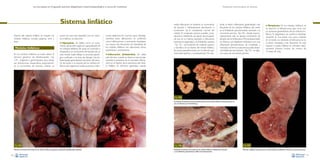 La necropsia en el ganado porcino, diagnóstico anatomopatológico y toma de muestras

Sistema linfático
Dentro del sistema linfático se incluyen los
nódulos linfáticos, tonsilas palatinas, timo y
bazo.

Nódulos linfáticos
En los nódulos linfáticos se suele utilizar el
término genérico de linfadenopatía –Fig.
154– (regional o generalizada) para designar alteraciones inespecíficas, especialmente el incremento de tamaño. Desde un

punto de vista más específico, en los nódulos linfáticos se describe:

• Hiperplasia. Se define como un incre-

mento del tamaño regional o generalizado de
los nódulos linfáticos, de causa no conocida o
inespecífica. Un incremento del tamaño de un
solo nódulo suele reflejar un proceso patológico confinado a su zona de drenaje. Una linfadenopatía generalizada (aumento del tamaño de todos o la mayoría de los nódulos linfáticos del organismo) suele asociarse a infec-

ciones sistémicas. En muchos casos, histológicamente, estas alteraciones se confirman
como inflamaciones o, raramente, neoplasias.
Las causas más frecuentes de hiperplasia de
los nódulos linfáticos son infecciones víricas,
bacterianas y protozoarias.

• Inflamación

(linfadenitis). Se utiliza
este término cuando se observa macroscópicamente la presencia de un exudado inflamatorio en el interior de la estructura del nódulo linfático. En términos generales, cuando

Evaluación macroscópica de vísceras

existe inflamación se advierte un incremento
de tamaño y habitualmente disminución o
incremento de la consistencia normal del
nódulo. En el ganado porcino, pueden considerarse la linfadenitis purulenta (acumulación
de pus en su interior, asociado a infecciones
bacterianas regionales) y la linfadenitis caseosa
–Fig. 155– (acumulación de material caseoso
y necrótico en el interior del nódulo linfático.
Se asocia específicamente con la infección por
Salmonella typhisuis y micobacterias). No obs-

tante, la lesión inflamatoria generalizada más
frecuente de los nódulos linfáticos del cerdo
es la linfadenitis granulomatosa asociada a la
circovirosis porcina –Fig. 156–, donde macroscópicamente sólo se aprecia incremento de
tamaño de los linfonodos. Microscópicamente
se observa una depleción linfocitaria con una
inflamación granulomatosa de moderada a
marcada. De forma ocasional se puede observar linfadenitis necrotizante –Fig.157– en algunos casos de circovirosis porcina.

• Neoplasias. En los nódulos linfáticos se

ha descrito el linfosarcoma, que cursa con
un aumento generalizado de los nódulos linfáticos. El diagnóstico se confirma histológicamente. Es una lesión muy poco habitual
en el cerdo; no obstante, el linfosarcoma es
la lesión neoplásica más frecuente en esta
especie y puede hallarse en animales relativamente jóvenes, incluso de menos de
3 meses de vida.

❋

Fig. 155
Incremento de tamaño y necrosis caseosa difusa de los nódulos linfáticos mesentéricos en un
caso de infección por Salmonella spp.

❋

Fig. 154
Marcado incremento de tamaño de los nódulos linfáticos inguinales superficiales (linfadenopatía regional).
90

Fig. 156
Moderado incremento de tamaño de los nódulos linfáticos mediastínicos asociado
a una linfadenitis granulomatosa visible microscópicamente.

Fig. 157
Necrosis multifocal (asteriscos) de un nódulo linfático mediastínico asociada a circovirosis porcina.
91

 