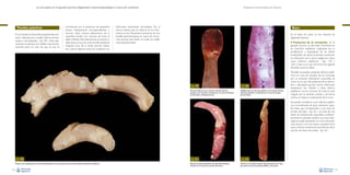 La necropsia en el ganado porcino, diagnóstico anatomopatológico y toma de muestras

Tonsilas palatinas
En las tonsilas se describen básicamente procesos inflamatorios: tonsilitis fibrino-necrotizantes o necrotizantes –Fig. 158–. Estas alteraciones no siempre son visibles macroscópicamente, pero en caso de que así sea, se

caracterizan por la presencia de pequeños
puntos blanquecinos correspondientes a
necrosis hasta masivas alteraciones de la
superficie tonsilar con necrosis de todo el
tejido linfoide. Estas alteraciones se asocian a
infecciones víricas (virus de la enfermedad de
Aujeszky, virus de la peste porcina clásica,
etc.), que en algunos casos se complican con

Evaluación macroscópica de vísceras

infecciones bacterianas secundarias. De la
misma manera que se observa en los linfonodos, es muy frecuente la presencia de una
tonsilitis granulomatosa en casos de circovirosis porcina; esta lesión no suele ser visible
macroscópicamente.

Bazo
En el bazo de cerdo se han descrito las
siguientes lesiones:

• Trastornos de la circulación. En el

ganado porcino se describen trombosis en
las arteriolas esplénicas originadas por la
proliferación y espongiosis de las células
endoteliales de dichas arteriolas, resultando
en infartación de la zona irrigada por estos
vasos (infartos esplénicos –Figs. 159 y
160–); este es el caso de las formas agudas
de peste porcina clásica.

Fig. 159
Necrosis isquémica de un extremo del bazo (infarto)
asociada a una vasculitis necrotizante en un caso de síndrome
de dermatitis y nefropatía porcina.

Fig. 160
Múltiples focos de necrosis isquémica en los bordes del bazo
(infartos) asociados a la infección por el virus de la peste
porcina clásica.

También se pueden presentar infartos esplénicos en caso de oclusión de las arteriolas
por un proceso inflamatorio (vasculitis), tal
como en el caso del síndrome de la dermatitis y nefropatía porcina, ciertas infecciones
bacterianas, etc. Debido a estos infartos
esplénicos ocurre necrosis de toda la zona
irrigada por la arteriola ocluida, y de forma
crónica se observa cicatrización de la zona.
Se pueden considerar como infartos esplénicos, normalmente de gran extensión, aquellas áreas que corresponden a una zona de
torsión del bazo –Fig. 161–; se trata de una
lesión de presentación esporádica, preferentemente en animales adultos. Las zonas infartadas se suelen presentar con una coloración
más oscura y con una mayor consistencia. En
casos crónicos evoluciona hacia fibrosis de la
porción de bazo necrosada –Fig. 162–.

Fig. 158
Presencia de múltiples focos de necrosis blanquecinos en el parénquima de la tonsila (tonsilitis necrotizante multifocal).
92

Fig. 161
Necrosis de aproximadamente la mitad del parénquima
del bazo en el caso de una torsión del mismo.

Fig. 162
Fibrosis con marcada retracción del parénquima de un bazo
que sufrió una necrosis extensa debido a una torsión.
93

 