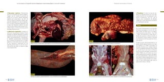 La necropsia en el ganado porcino, diagnóstico anatomopatológico y toma de muestras

Evaluación macroscópica de vísceras

•

•

Hiperplasia esplénica. Habitualmente
cursa con un aumento de volumen (esplenomegalia –Fig. 163– debido al incremento de
tamaño de la porción linfoide (hiperplasia
esplénica de la pulpa blanca –Fig. 164–. Al
corte se observan pequeños nódulos blanquecinos distribuidos por todo el parénquima, y se asocia a infecciones sistémicas) o de
la pulpa roja (hiperplasia esplénica de pulpa
roja.Al corte se observa que el bazo ha acumulado sangre, y se asocia a torsiones, anemia
hemolítica isoinmune, etc.).

Neoplasias. En todos los casos, las neoplasias en el ganado porcino son muy infrecuentes. De entre las más habituales se destacaría el linfosarcoma –Fig. 165–, que se
observa como nodulaciones de diámetro
variable de un color blanquecino-amarillento,
en el parénquima del bazo.

Timo
En el cerdo prácticamente no se describen
alteraciones patológicas en el timo. No obstante, existe una lesión que sí es relativamente frecuente: atrofia del timo –Figs. 166A
y 166B–. Esta alteración se suele asociar a
estados de caquexia o retraso marcado en
el crecimiento, aunque también se describe
con frecuencia en formas graves de circovirosis porcina.

•

Inflamación (esplenitis). Consiste en la
inflamación del parénquima esplénico. Puede
presentar un infiltrado inflamatorio purulento
(esplenitis purulenta,que habitualmente no es
visible macroscópicamente), o granulomatoso (esplenitis granulomatosa, caracterizada
por la presencia de granulomas en el tejido
esplénico; la tuberculosis sería el caso típico).
Es muy frecuente la observación de una
esplenitis granulomatosa en casos de circovirosis porcina; esta lesión no suele ser visible
macroscópicamente.

Fig. 163
Marcado incremento de tamaño del bazo (esplenomegalia) en un caso de infección sistémica por Salmonella choleraesuis.

Múltiples nodulaciones blanquecinas en la superficie de un bazo afectado por un linfosarcoma.

A

Fig. 164
Hiperplasia de la pulpa blanca (punteado blanquecino) en un bazo incrementado de tamaño (esplenomegalia).
94

Fig. 165

B

A pesar de que macroscópicamente no se
puedan apreciar algunas lesiones en los órganos linfoides, en el análisis microscópico es
frecuente encontrar una condición descrita
como una depleción linfocitaria. Ésta consiste
en una disminución del número de linfocitos
que forman parte del órgano concreto (timo,
nódulo linfático, etc.), de manera que se evidencia perfectamente el estroma del órgano.
Se asocia habitualmente a infecciones víricas;
entre ellas se destaca especialmente la circovirosis porcina, aunque también se ha observado en otras enfermedades tales como la
peste porcina clásica y africana.

Fig. 166
Timo normal (A) y timo marcadamente atrófico (B) (flecha). Éste último corresponde a un cerdo afectado de circovirosis porcina.
95

 