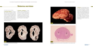 La necropsia en el ganado porcino, diagnóstico anatomopatológico y toma de muestras

Evaluación macroscópica de vísceras

Sistema nervioso
En el sistema nervioso se describen:

•

Anomalías congénitas. En el cerdo son
poco frecuentes. La más usual es la hidrocefalia –Fig. 167–, que consiste en un aumento
de volumen del líquido cefalorraquídeo en las
cavidades del cerebro; aunque generalmente
se trata de un problema congénito, también
puede ser adquirido (secundario a otros procesos, generalmente de carácter inflamatorio). Otras lesiones, como la hipoplasia cerebelar (disminución del tamaño del cerebelo),
se asocia a infecciones congénitas con virus
de la peste porcina clásica.

• Necrosis. La necrosis del tejido nervioso

del encéfalo y de la médula espinal se denomina malacia; encefalomalacia y mielomalacia
respectivamente, utilizándose los prefijos
polio- o leuco- para designar la afectación de
la sustancia gris o blanca. Estas lesiones no son
visibles macroscópicamente; histológicamente
se observan como amplias zonas de necrosis
y destrucción del tejido nervioso –Fig. 169–.
Estas patologías están relacionadas con formas subagudas y crónicas de la enfermedad
de los edemas, intoxicación por selenio
(especialmente mielomalacia en la zona lumbar), deficiencia de vitamina E y selenio e intoxicación por sal.

• Trastornos

circulatorios. El edema
cerebral se describe especialmente en la
enfermedad de los edemas. No obstante, se
trata de una lesión de difícil valoración
macroscópica y, en general, su diagnóstico es
microscópico. Las hemorragias –Fig. 168–
cerebrales son poco frecuentes y suelen asociarse a alteraciones que cursan con diátesis
hemorrágica o bien, en la mayor parte de los
casos, a traumatismos cráneo-encefálicos.

Fig. 168
Hemorragias en el cerebelo, asociadas a un proceso de diátesis hemorrágica.

Fig. 167
Dilatación moderada del sistema ventricular del cerebro (hidrocefalia).
96

Fig. 169
Encefalomielomalacia bilateral simétrica de las astas ventrales de la médula espinal (flechas) en un caso de intoxicación por selenio.
Tinción de HE.
97

 