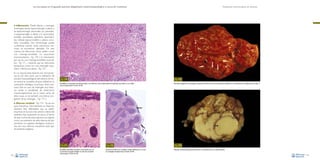 La necropsia en el ganado porcino, diagnóstico anatomopatológico y toma de muestras

Evaluación macroscópica de vísceras

•

Inflamación. Puede afectar a meninges
(meningitis, siendo leptomeningitis si afecta a
las leptomeninges, aracnoides y/o piamadre,
o paquimeningitis si afecta a la duramadre),
encéfalo (encefalitis), epéndimo (ependimitis), médula espinal (mielitis) y plexos coroideos (coroiditis). Esta terminología puede
combinarse cuando varias estructuras nerviosas se encuentran afectadas. De esta
manera, las infecciones víricas suelen cursar
con meningo-encefalitis no supurativas
(mononucleares, –Fig. 170–), la intoxicación
por sal con una meningo-encefalitis eosinofílica –Fig. 171–, mientras que las infecciones
bacterianas cursan con una meningitis supurativa o fibrino-purulenta –Fig. 172–.
En su mayoría, estas lesiones son microscópicas; es por esta razón que la realización de
estudios histopatológicos del sistema nervioso central se considera de gran utilidad en la
orientación etiológica al proceso clínico nervioso. Sólo en caso de meningitis muy intensas existe la posibilidad de observarlas
macroscópicamente (en la mayor parte de
estos casos, se da también una intensa congestión de las meninges, –Fig. 173–).

Fig. 170

Fig. 173

Encefalitis no supurativa marcada asociada a una infección vírica (enfermedad de Aujeszky); esta lesión no es visible
macroscópicamente.Tinción de HE.

Marcada congestión de meninges y presencia de fibrina entre circunvoluciones (flechas) en una infección por Streptococcus suis tipo 2.

•

Absceso cerebral –Fig. 174–. Se da con
poca frecuencia. Normalmente se observan
abscesos bien delimitados que se suelen
encontrar en la zona más ventral y lateral del
cerebelo. Esta localización se asocia al hecho
de que muchos de estos abscesos se originan
como una extensión de otitis internas de tipo
purulento. Los agentes etiológicos involucrados son muy diversos, incluyendo todo tipo
de bacterias piógenas.

Fig. 171
Encefalitis eosinofílica asociada a intoxicación por sal
(o privación de agua); también se trata de una lesión
microscópica.Tinción de HE.
98

Fig. 172
Presencia de fibrina en cerebelo y puente (flechas) en un caso
de meningitis estreptocócica.Tinción de HE.

Fig. 174
Absceso cerebral (flecha) provocado por una extensión de una otitis profunda.
99

 