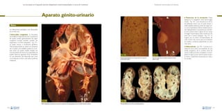 La necropsia en el ganado porcino, diagnóstico anatomopatológico y toma de muestras

Evaluación macroscópica de vísceras

Aparato génito-urinario

• Trastornos de la circulación.

Debe
destacarse la congestión renal, hemorragias
renales –Fig. 176– (con frecuencia en forma
de petequias, hecho que se suele asociar a
enfermedades sistémicas, tanto de origen vírico como bacteriano), infartos renales (asociados habitualmente a oclusiones por trombosis de la arteria renal o alguna de sus ramas;
la imagen macroscópica suele consistir en una
zona más o menos triangular –Fig. 177–, la
irrigada por la arteria correspondiente, de
color mucho más oscuro, que con el tiempo
se cronifica y se fibrosa, adquiriendo un color
más claro).

Riñón
Las alteraciones patológicas más destacables
en el riñón son:

•

Anomalías congénitas. Su frecuencia
es variable en el ganado porcino. La presencia
de quistes renales (generalmente de origen
congénito, aunque también pueden ser
adquiridos) o el riñón poliquístico –Fig. 175–
se suelen asociar a condiciones genéticas.
Macroscópicamente se observa la presencia
de un quiste o de múltiples quistes en la corteza renal. Los quistes renales simples son
muy frecuentes. De forma muy esporádica, se
puede observar agenesia renal, consistente
en una alteración del desarrollo que cursa
con la falta de un riñón y del uréter (suele ser
unilateral).

• Hidronefrosis –Fig. 178–. Consiste en la
Fig. 176
Petequias generalizadas en la corteza renal en un caso de
peste porcina clásica.

Fig. 175
Riñón poliquístico. En general se trata de una alteración de origen genético que no ocasiona síntomas clínicos.
100

Fig. 177
Necrosis isquémica por oclusión arterial en el riñón
(infarto renal).

dilatación de la pelvis acompañada de una
atrofia progresiva de la corteza renal. Se
asocia a obstrucciones completas o incompletas en algún punto entre la pelvis renal y
la uretra, usualmente producida por cálculos renales.

Fig. 178
Marcada dilatación de la pelvis renal (hidronefrosis).
101

 