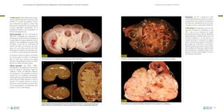 La necropsia en el ganado porcino, diagnóstico anatomopatológico y toma de muestras

Evaluación macroscópica de vísceras

Pielonefritis –Fig. 181–: consiste en la inflamación, generalmente purulenta, de la pelvis y
el parénquima renal, y suele ser consecuencia
de infecciones ascendentes de las vías urinarias bajas. Se asocia a infecciones bacterianas.

• Inflamación. Puede afectar sólo a los glo-

mérulos (glomerulitis), sólo al intersticio renal
(nefritis) o a la pelvis renal (pielitis), o bien a
una combinación de algunas o todas estas
estructuras. La observación macroscópica de
la lesión dependerá directamente de la
extensión de la lesión y de su intensidad. Las
formas más habituales son:
Glomerulonefritis –Fig. 179–: se trata de una
inflamación combinada de los glomérulos y
del intersticio renal. En la forma más aguda no
se suele observar ninguna alteración macroscópica. En casos subagudos, el proceso suele
ser difuso y cursa con un incremento del
tamaño del riñón, con frecuencia con petequias y con una corteza renal de color amarillo-grisáceo;la médula renal suele estar intacta y el riñón se puede decapsular fácilmente.
En procesos crónicos se observa una superficie cortical rugosa y el riñón no se decapsula
bien. En casos muy crónicos, con marcada
retracción del parénquima renal, no se distingue de una nefritis intersticial crónica.
Nefritis intersticial –Figs. 180A y 180B–:
corresponde a una inflamación del intersticio
renal, sin afectación glomerular. Puede ser
multifocal o difusa, con infiltrados inflamatorios purulentos o no purulentos. Las formas
crónicas son muy evidentes macroscópicamente, dado que existe sustitución del parénquima renal por tejido conjuntivo y de cicatrización. En el ganado porcino se asocia a
infecciones víricas (circovirosis porcina como
la más representativa) y/o bacterianas (leptospirosis como la más habitual).

• Neoplasias.En el ganado porcino es relativamente frecuente el nefroblastoma –Fig.
182–, que es una neoplasia de origen
embrionario. Este tumor suele ser detectado
especialmente en matadero dado que cursa
de forma subclínica, a no ser que por su
tamaño provoque la compresión de alguna
víscera abdominal que genere sintomatología de algún tipo. Suele tener un crecimiento
bastante grande, provocando incluso distensión del abdomen. Puede ser unilateral o bilateral, y presenta una superficie rugosa y lobulada, con necrosis y hemorragias al corte en
caso de gran crecimiento.

Fig. 179

Fig. 181

Glomerulonefritis crónica con rugosidad de la corteza renal, acompañada de hidronefrosis.

A

B

Fig. 180
Presencia generalizada de manchas blanquecinas en la corteza renal (nefritis intersticial) en un caso de circovirosis porcina (A).
Nefritis intersticial crónica caracterizada por incremento de tamaño del riñón y la corteza renal pálida debido a fibrosis (B).
102

Cúmulo de un material fibrino-purulento en la pelvis renal (pielonefritis purulenta), la cual se encuentra a su vez dilatada.

Fig. 182
Masiva proliferación de un tejido sólido blanquecino derivado del riñón que corresponde a un nefroblastoma.
103

 