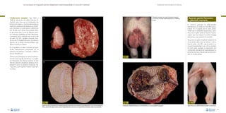 La necropsia en el ganado porcino, diagnóstico anatomopatológico y toma de muestras

• Inflamación

(orquitis –Figs. 186A y
186B–). Inflamación del tejido testicular. En
muchos casos cursa con un incremento del
tamaño del órgano, y macroscópicamente se
observa la presencia de abscesos en el testículo. Esta lesión se suele asociar a infecciones
por Brucella suis. Ciertos virus pueden aislarse del semen, pero no se han descrito orquitis o lesiones manifiestas en estas infecciones,
a excepción de la infección por el virus del
ojo azul –Fig. 187–, también conocido como
el virus de La Piedad-Michoacán (rubulavirus
porcino de la familia Paramixoviridae) que
afecta a cerdos en México.

Evaluación macroscópica de vísceras

Moderado incremento de tamaño del testículo izquierdo
en un verraco inoculado experimentalmente con rubulavirus
porcino.

A

En términos generales, las enfermedades
reproductivas en cerdas son de difícil aproximación. En la mayoría de los casos, clínicamente sólo se presentan repeticiones y abortos, y no se suelen observar lesiones macroscópicas que nos indiquen la posible etiología
del proceso que padecían los animales.
En la vulva se suelen considerar trastornos de
la circulación, tales como el edema o tumefacción vulvar –Fig. 189–, que se asocia a un
proceso fisiopatológico, caso de los animales
en estro, pero también a intoxicación por
micotoxinas (zearalenona), especialmente en
lechones de pocos días de vida, aunque también en cerdas adultas.

En el epidídimo se debe considerar la epididimitis, habitualmente caracterizada por la
presencia de abscesos y asociada a infecciones por Brucella suis.
Alteraciones patológicas en otras localizaciones del tracto genital del verraco no suelen
ser frecuentes. De forma ocasional se han
descrito lesiones neoplásicas benignas en el
prepucio, como el papiloma prepucial (Fig.
–Fig. 188–), pero apenas revisten importancia clínica.

Fig. 187
B

Fig. 186
Masivo incremento de tamaño de un testículo (derecha) comparado con un testículo normal (izquierda) en un caso de brucelosis (A).
Mismo testículo de la figura anterior abierto longitudinalmente, mostrando una orquitis fibrino-necrotizante difusa muy intensa (B).
106

Aparato genital femenino
y glándula mamaria

Fig. 188
Proliferación neoplásica benigna en la zona prepucial en un verraco (papiloma prepucial).

Fig. 189
Edema vulvar en un lechón neonato asociado a micotoxicosis.
107

 