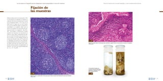 La necropsia en el ganado porcino, diagnóstico anatomopatológico y toma de muestras

Toma de muestras para el estudio patológico y otras consideraciones prácticas

Fijación de
las muestras
Debería utilizarse formol tamponado al 10%.
A nivel práctico, no obstante, es suficiente la
utilización del formol comercial que se vende
en las droguerías diluido 1:10. Lo que no se
debe hacer en ningún caso con una muestra
en la cual se pretenda realizar un estudio histopatológico es congelarla (dado que se
forma una cantidad muy importante de artefactos asociados a la congelación –Figs. 206 y
207–, que tienden a enmascarar la posible
existencia de lesiones). Se recomienda en
todos los casos utilizar contenedores de plástico con cierre hermético (los botes de cristal se rompen con gran facilidad durante el
transporte), llenados hasta las 4/5 partes de
su capacidad con formol. Es muy importante, especialmente para evitar la autolisis incluso dentro del bote de formol, que la proporción entre el volumen de tejido fijado y el
volumen de formol sea aproximadamente
de 1:5 a 1:10 –Fig. 208–.

Fig. 207
Imagen de un nódulo linfático al microscopio óptico previamente congelado. Nótese la masiva presencia de artefactos de congelación.
Tinción de HE.

Correcta fijación de tejidos para
su posterior evaluación microscópica
(izquierda) en comparación con una
fijación deficiente (derecha).

Fig. 206

Fig. 208

Imagen normal de un nódulo linfático al microscopio óptico. Nótese la presencia bien delimitada de las estructuras foliculares.
Tinción de HE.
118

119

 