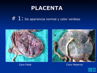 PLACENTA  # 1:  De apariencia normal y color verdoso Cara Fetal Cara Materna 