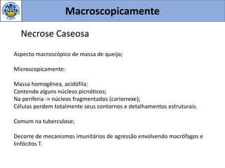 Macroscopicamente
Necrose Caseosa
Aspecto macroscópico de massa de queijo;
Microscopicamente:
Massa homogênea, acidófila;
Contendo alguns núcleos picnóticos;
Na periferia -> núcleos fragmentados (cariorrexe);
Células perdem totalmente seus contornos e detalhamentos estruturais.
Comum na tuberculose;
Decorre de mecanismos imunitários de agressão envolvendo macrófagos e
linfócitos T.
 