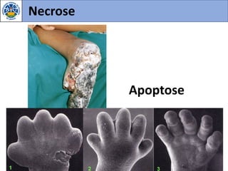 Necrose
Apoptose
 