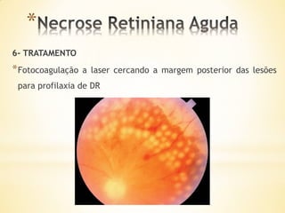 *
6- TRATAMENTO
* Fotocoagulação   a laser cercando a margem posterior das lesões
 para profilaxia de DR
 