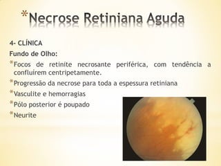 *
4- CLÍNICA
Fundo de Olho:
* Focos  de retinite necrosante periférica, com tendência a
 confluírem centripetamente.
* Progressão da necrose para toda a espessura retiniana
* Vasculite e hemorragias
* Pólo posterior é poupado
* Neurite
 