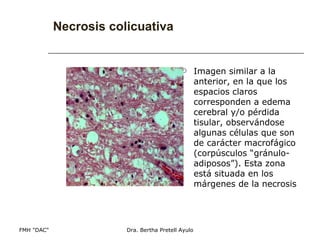 Necrosis colicuativa Imagen similar a la anterior, en la que los espacios claros corresponden a edema cerebral y/o pérdida tisular, observándose algunas células que son de carácter macrofágico (corpúsculos “gránulo-adiposos”). Esta zona está situada en los márgenes de la necrosis 
