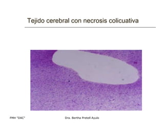 Tejido cerebral con necrosis colicuativa 