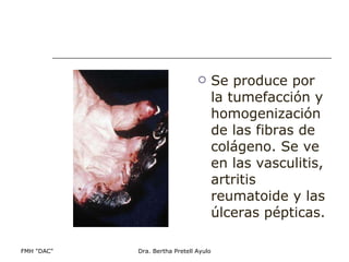 Se produce por la tumefacción y homogenización de las fibras de colágeno. Se ve en las vasculitis, artritis reumatoide y las úlceras pépticas. 
