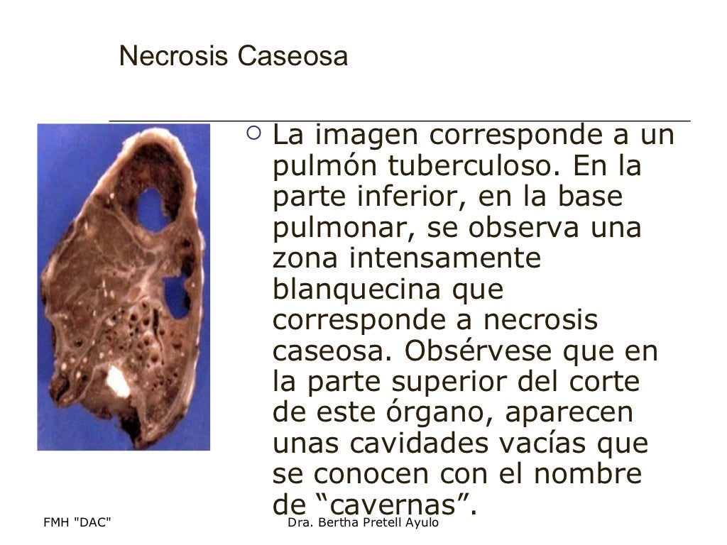 Necrosis