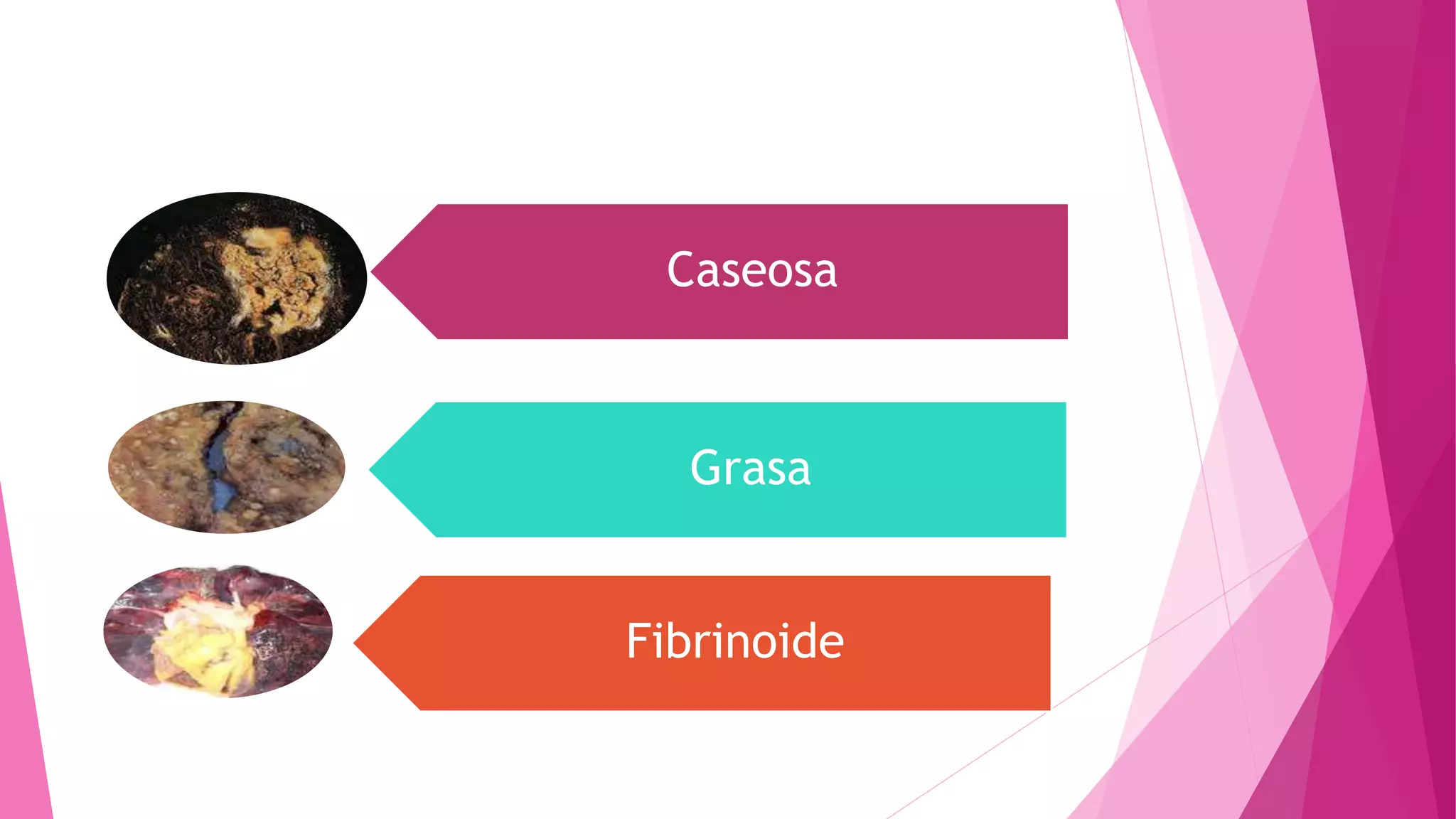Caseosa
Grasa
Fibrinoide