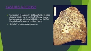 CASEOUS NECROSIS
 Combination of coagulative and liquefactive necrosis
characterized by the presence of soft, dry, cheesy
homogenous necrotic material but it is not liquified.
Formulation of granuloma cell takes place.
 EXAMPLE- in tuberculous granuloma.
 