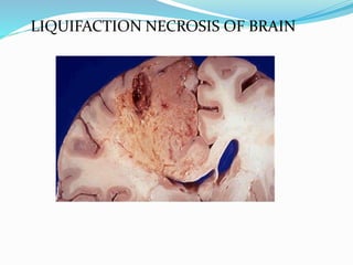 LIQUIFACTION NECROSIS OF BRAIN
 