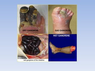 GAS GANGRENE
DRY GANGRENE
 