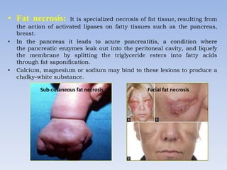 • Fat necrosis: It is specialized necrosis of fat tissue, resulting from
the action of activated lipases on fatty tissues such as the pancreas,
breast.
• In the pancreas it leads to acute pancreatitis, a condition where
the pancreatic enzymes leak out into the peritoneal cavity, and liquefy
the membrane by splitting the triglyceride esters into fatty acids
through fat saponification.
• Calcium, magnesium or sodium may bind to these lesions to produce a
chalky-white substance.
Sub-cutaneous fat necrosis Facial fat necrosis
 