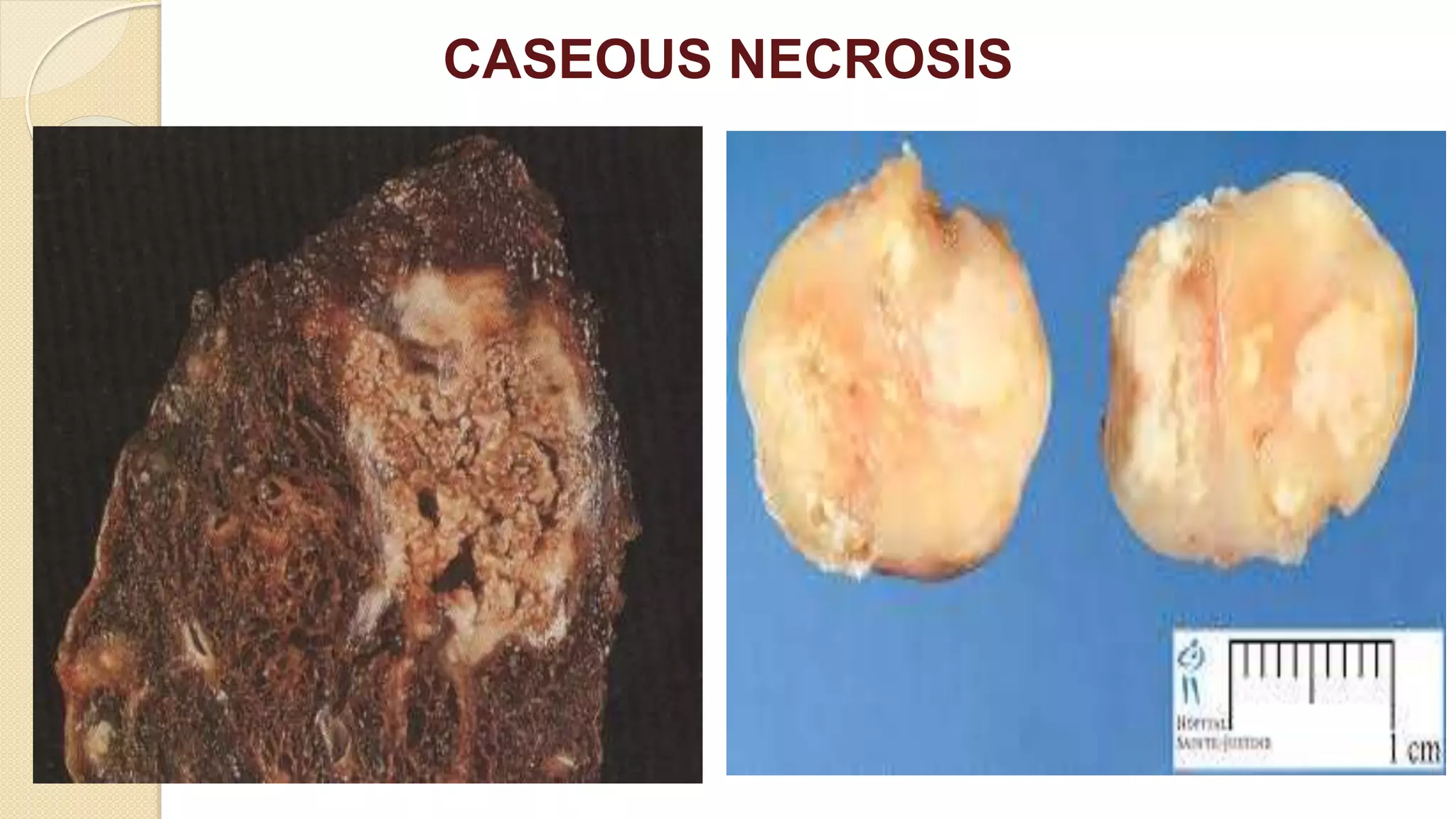 CASEOUS NECROSIS
 