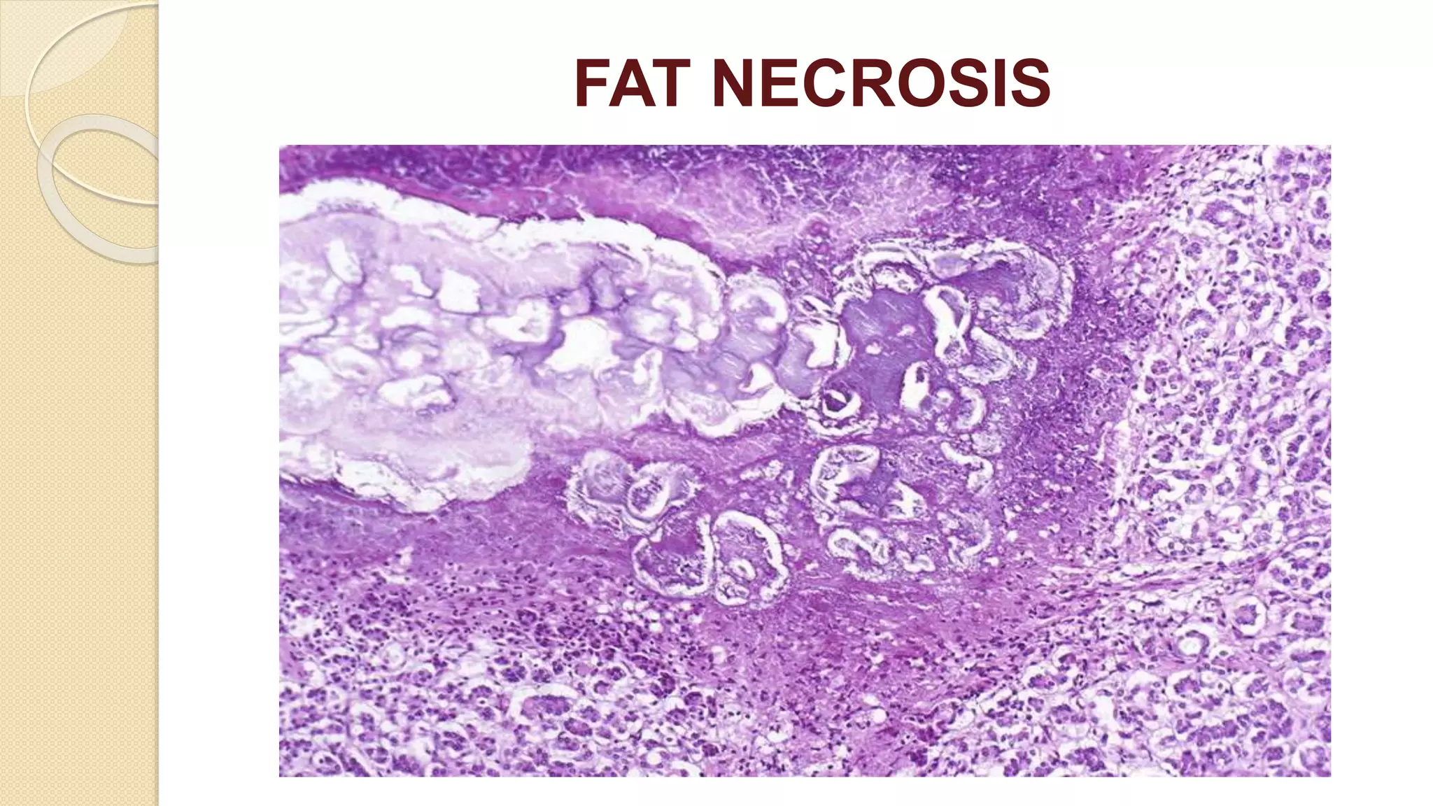 FAT NECROSIS
 