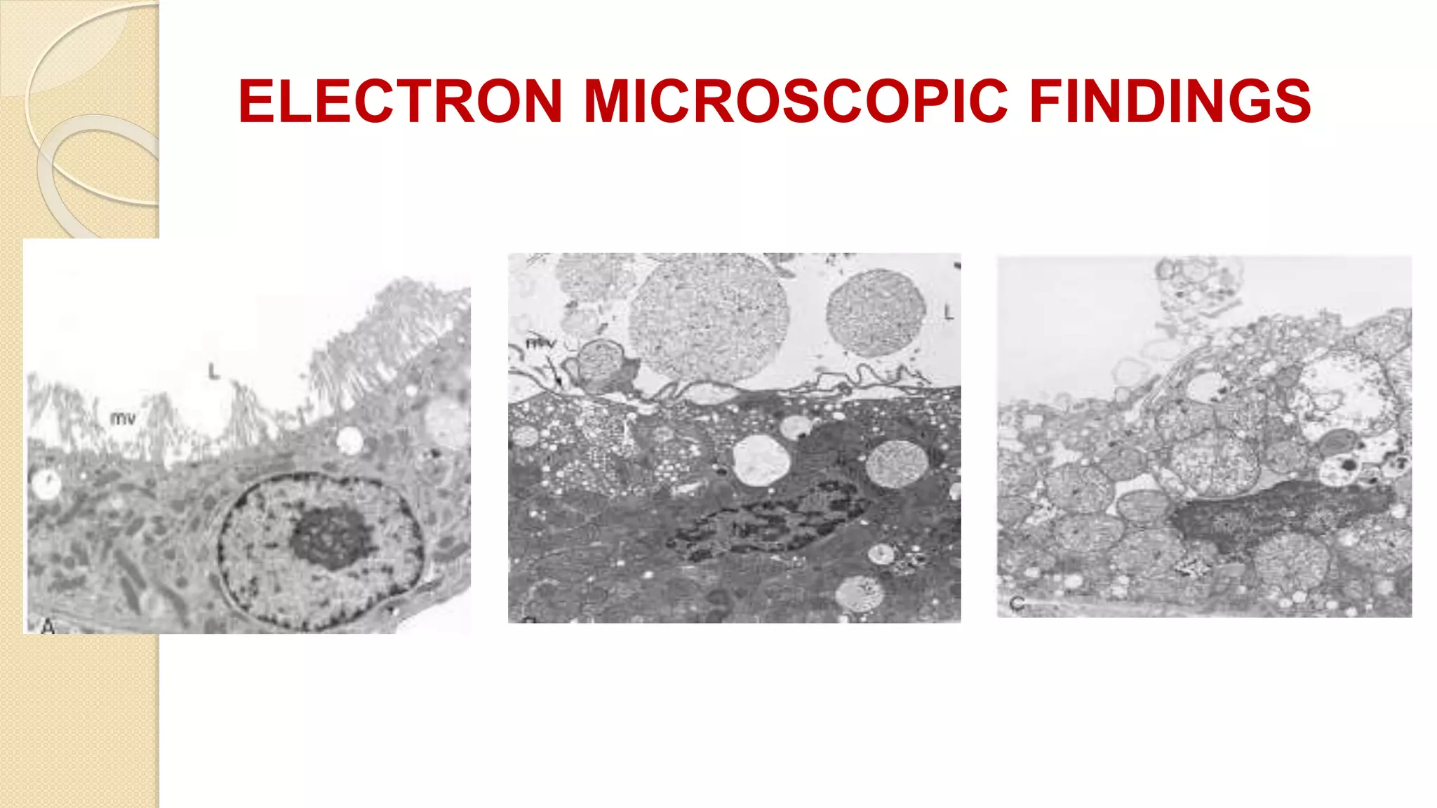 ELECTRON MICROSCOPIC FINDINGS
 