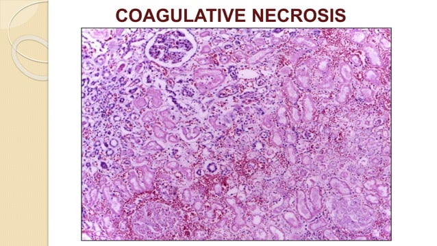 Necrosis pptx