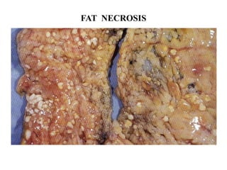 FAT NECROSIS
 