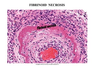 FIBRINOID NECROSIS
 