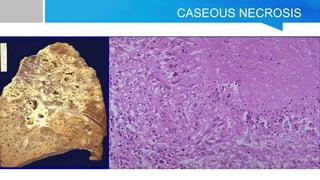 Caseation Hitopath NECROSIS FOR MBBS FIRST YEAR STUDENTS MADE EASY.pptx