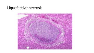 Liquefactive necrosis
 