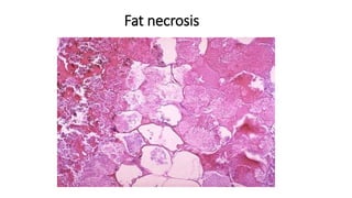 Fat necrosis
 