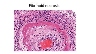 Fibrinoid necrosis
 