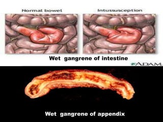 Wet gangrene of intestine
Wet gangrene of appendix
 