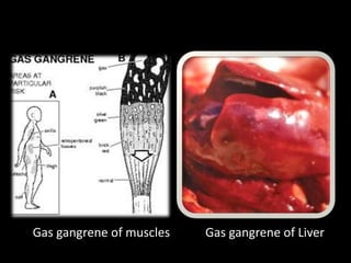 Gas gangrene of muscles Gas gangrene of Liver
 