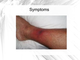 Necrosis Fasciitis ODP Necrosis Fasciitis ODP