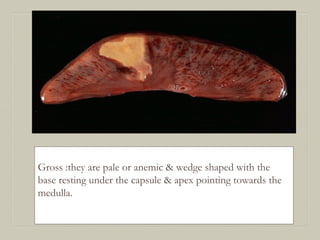 Gross :they are pale or anemic & wedge shaped with the
base resting under the capsule & apex pointing towards the
medulla.
 