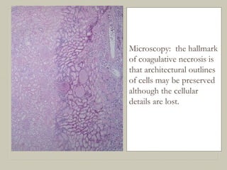 Microscopy: the hallmark
of coagulative necrosis is
that architectural outlines
of cells may be preserved
although the cellular
details are lost.
 