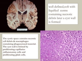 well defined,soft with
liquified centre
containing necrotic
debris later a cyst wall
is formed
-
The cystic space contains necrotic
cell debris & macrophages
containing phagocytosed material.
The cyst wall is formed by
proliferating capillaries
,inflammatory cells and
proliferating glials cells.
 