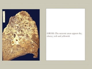 GROSS :The necrotic areas appear dry,
cheesy, soft and yellowish
 