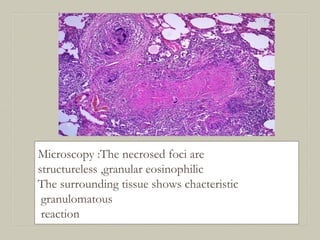 Microscopy :The necrosed foci are
structureless ,granular eosinophilic
The surrounding tissue shows chacteristic
granulomatous
reaction
 
