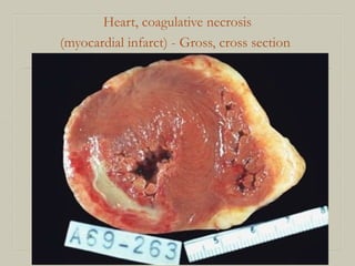Heart, coagulative necrosis
(myocardial infarct) - Gross, cross section
 
