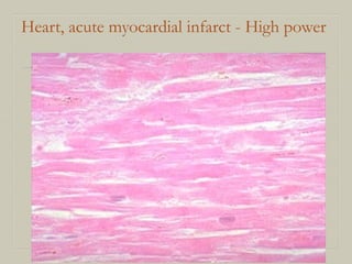 Heart, acute myocardial infarct - High power
 