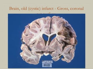 Brain, old (cystic) infarct - Gross, coronal
cut surface
 