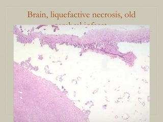Brain, liquefactive necrosis, old
cerebral infarct
 